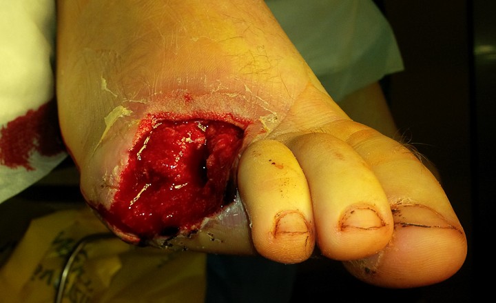 brazgotina po poškodbi