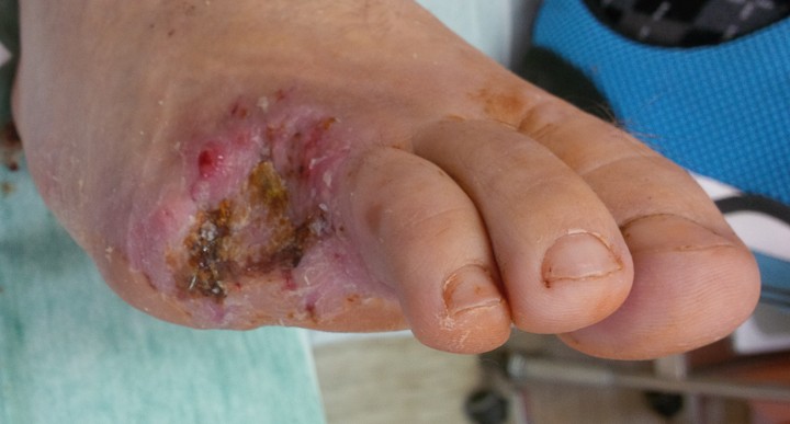 brazgotina po amputaciji prstov