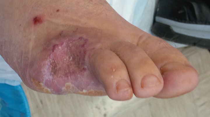 celjenje brazgotine po amputaciji