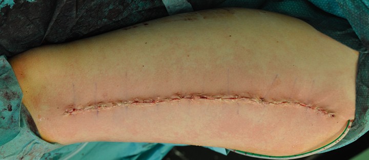 korekcija grde brazgotine