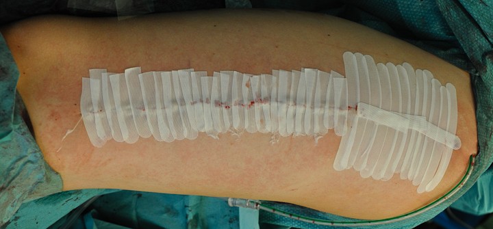 lepilni trakovi na brazgotini