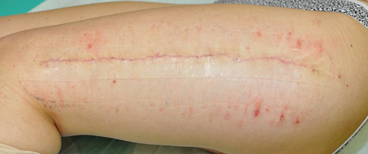 silikonski obliž na brazgotini