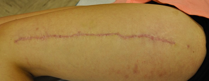 mlada brazgotina po korekciji