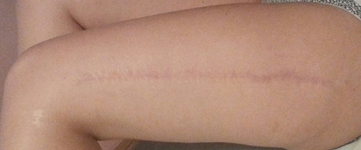 korekcija brazgotine končni izgled