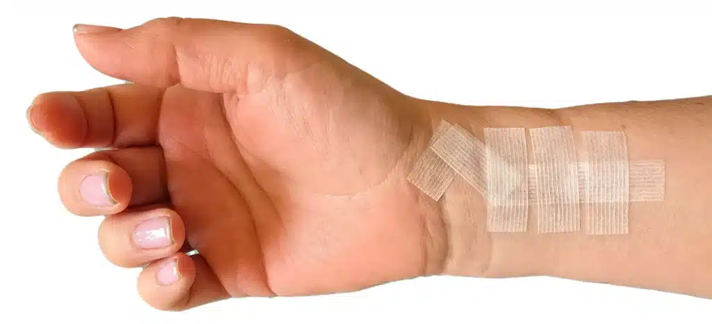 Brazgotine in steri strip